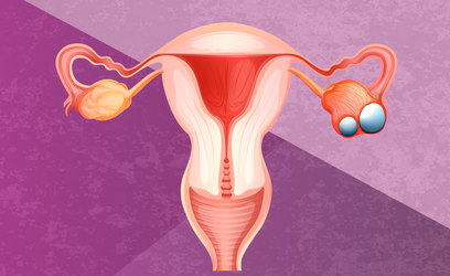 Cáncer de ovario, uno de los más agresivos si no se atiende a tiempo